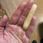 ATORVASTATIN SIDE EFFECTS: 15 Hidden Dangers Your Doctor May Not Tell You About