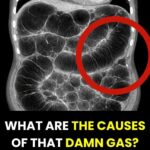 Colon cancer: early warning signs that deserve medical attention